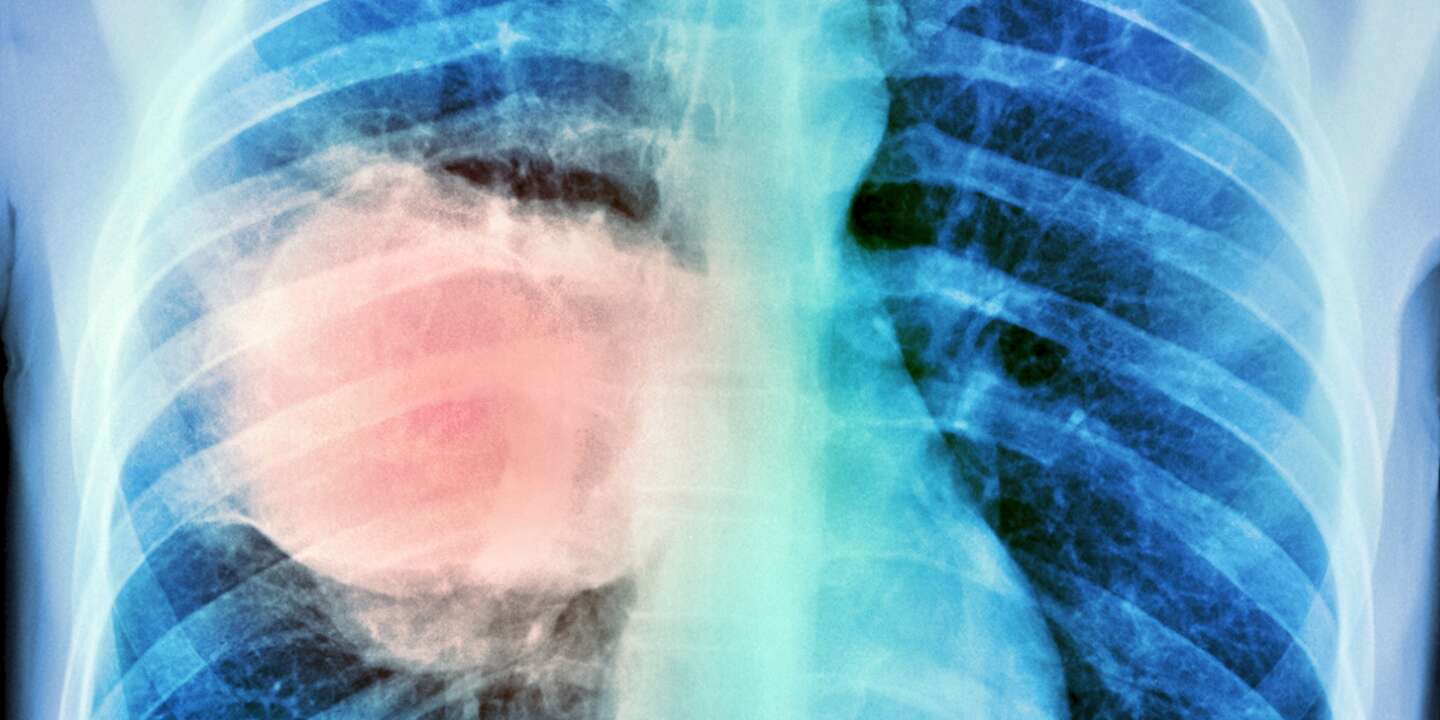 Cancer du poumon : la survie s'améliore en France