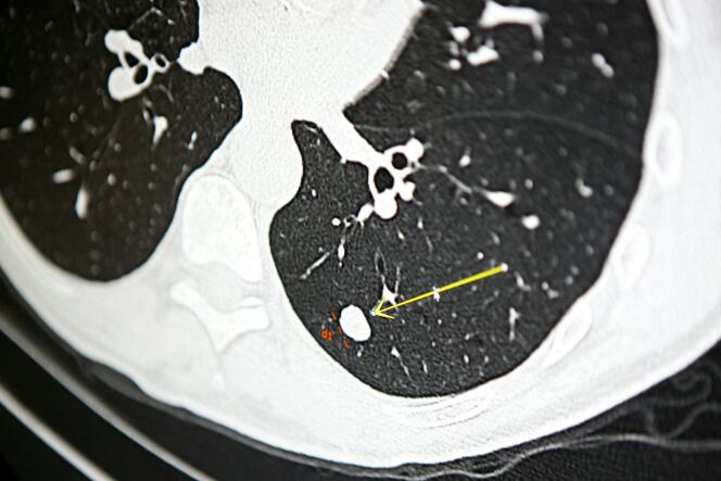 Un nódulo en un escáner pulmonar de un fumador para el experimento de detección de cáncer de pulmón 