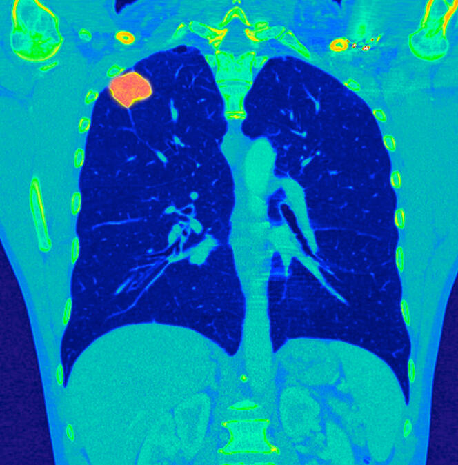 Scanner couleur de la partie supérieure du thorax montrant une tumeur au niveau du poumon. 

