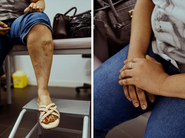 Fanta montre une cicatrice sur sa jambe, trace d’une blessure reçue en prison en Libye, dans le cabinet médical du docteur Jérémy Khouani, à Marseille, le 5 septembre 2023.