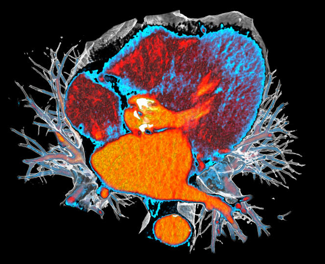 Tomographie 3D colorée d’un cœur montrant la calcification de la valve aortique (blanc vif, au centre). La calcification entraîne le durcissement de la valve, ce qui provoque une sténose (rétrécissement) de la valve aortique, qui ne s’ouvre plus complètement.