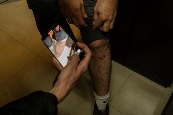 Un oncle d'Amin Al-Abbasi montre des petites blessures à la jambe qu’il impute à des policiers israéliens venus, selon lui, disperser la famille réunie determination    la libération du jeune homme, dans le quartier de Silwan, à Jérusalem-Est, en Israël.