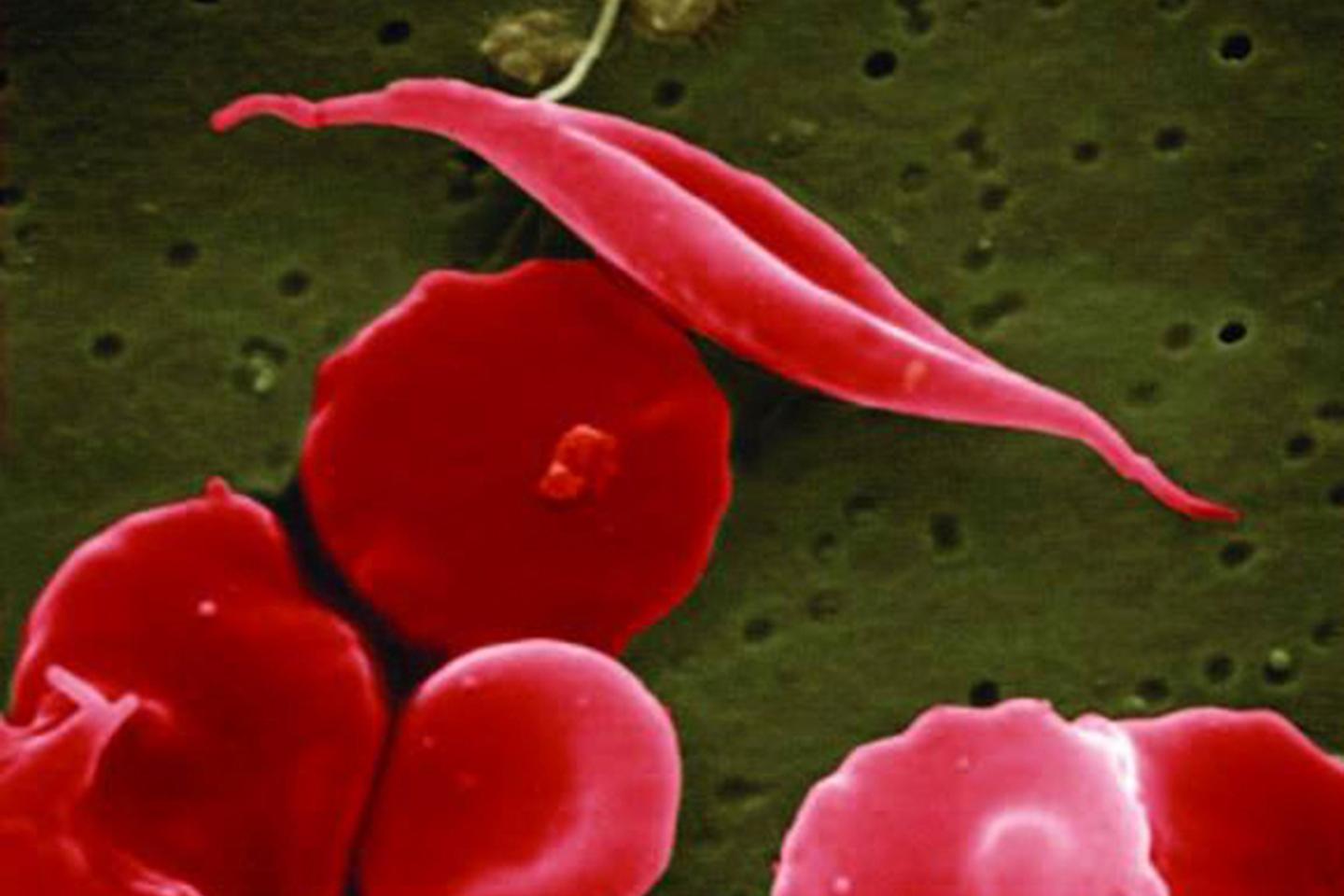 US approves breakthrough sickle cell therapy that uses gene-editing tool