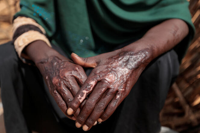 Une Soudanaise réfugiée à Adré, au Tchad, montre les brûlures sur ses mains, le 5 août 2023. En avril, les Forces de soutien rapide (FSR) ont incendié le camp de déplacés où elle vivait à Al-Geneina, dans l’ouest du Darfour.