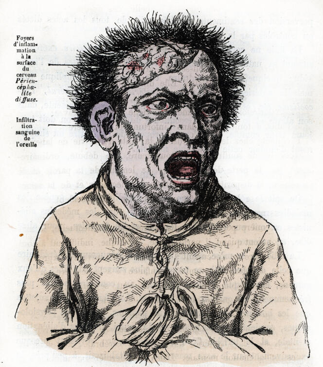 Un malade mental. Gravure extraite de « La Nature et l’homme », de Rengade (1881).