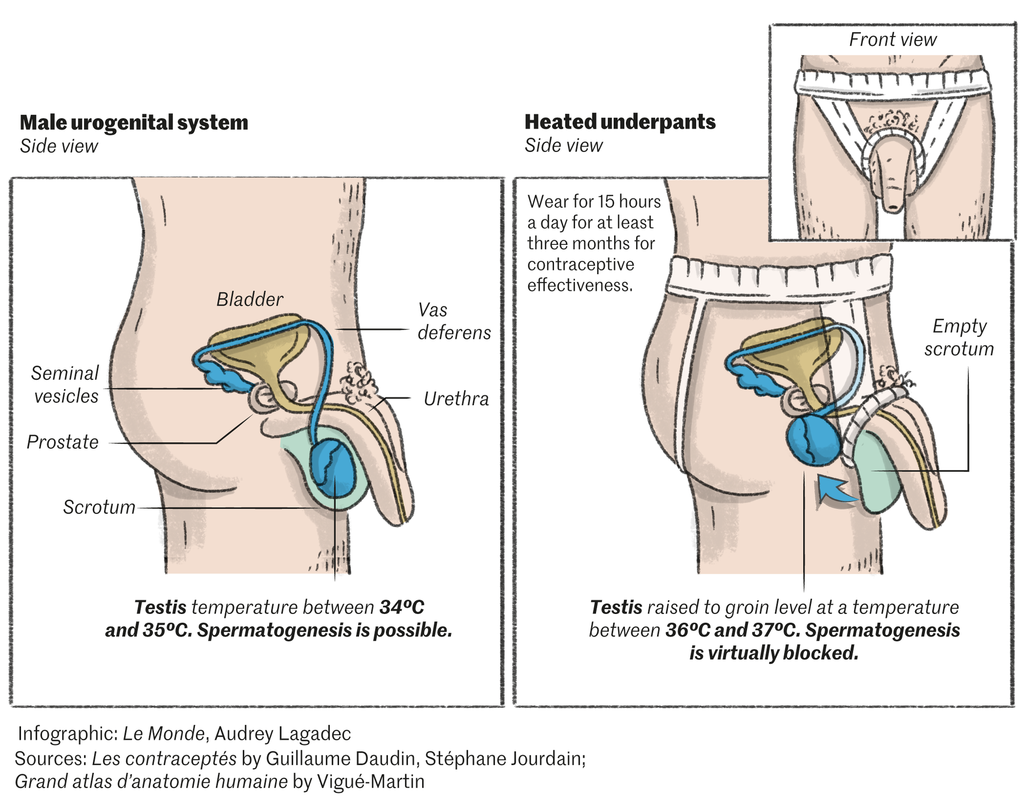 Heated underpants, a ring: Developing methods of thermal contraception for  men