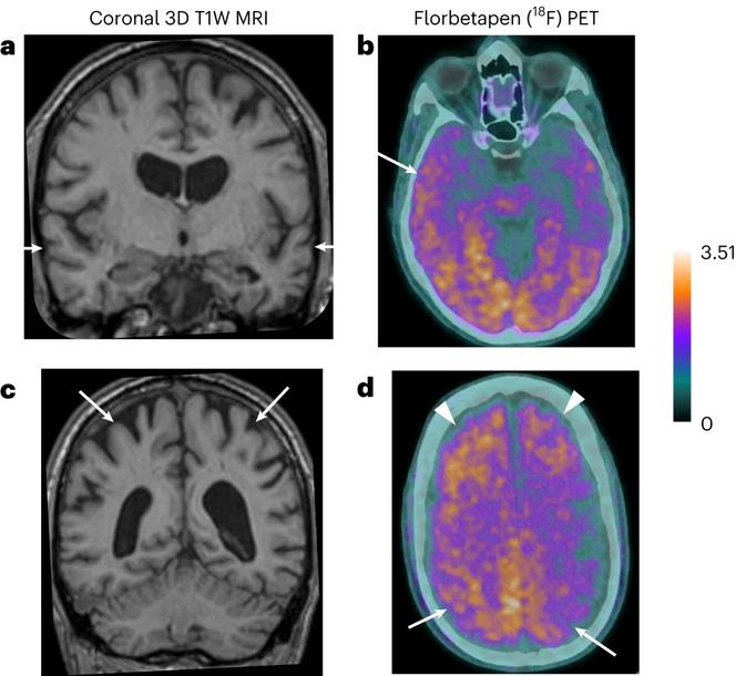 Vues par résonance magnétique et scanner PET du cerveau d’un des patients britanniques ayant été diagnostiqué comme souffrant de la maladie d’Alzheimer, plus de trois décennies après avoir reçu des injections d’hormone de croissance contaminées.
