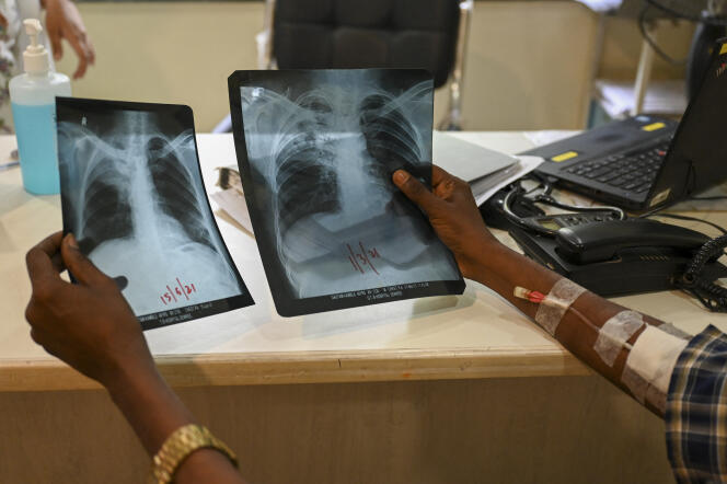 Un patient atteint de tuberculose consulte ses radiographies pulmonaires dans une clinique de Médecins sans frontières (MSF), à Bombay, en Inde, le 22 mars 2022.