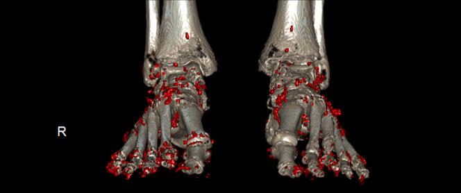 Scanner double énergie des pieds, mettant en évidence les cristaux d’urate, en rouge, à l’origine des épisodes d’inflammation articulaire.