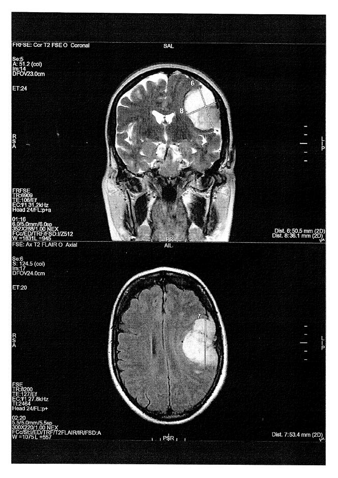 Imagerie par résonance magnétique (IRM) montrant un méningiome provoqué chez une victime par la prise d’Androcur, ou autres progestatifs.