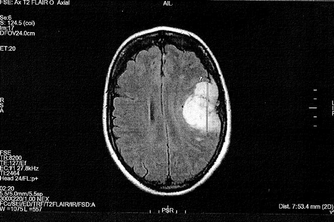 Imagerie par résonance magnétique (IRM) montrant un méningiome provoqué chez une victime par la prise d’Androcur, ou autres progestatifs.