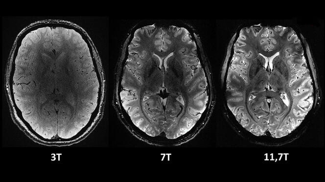 L'imagerie Iseult du CEA a livré ses premières images du cerveau humain.  Son champ magnétique de 11,7 Tesla en fait le plus puissant au monde.