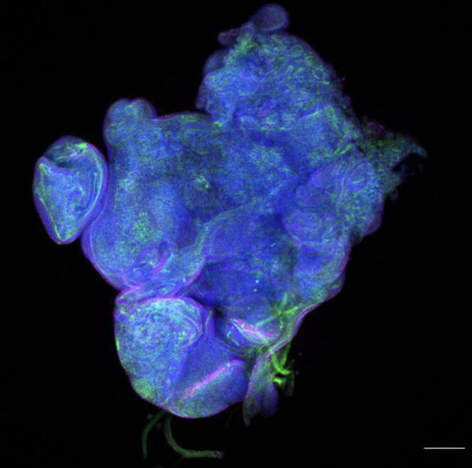 Une tumeur, amas de cellules anormales, provoquée par une perturbation épigénétique. L’ADN, coloré en bleu, n’est pas différent de celui d’une cellule saine. 