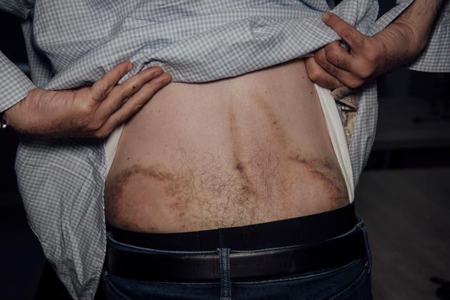 Gia Japaridze's back still bears the scars of the attack. Several men beat him up in front of his home. Tbilisi, May 18, 2024.