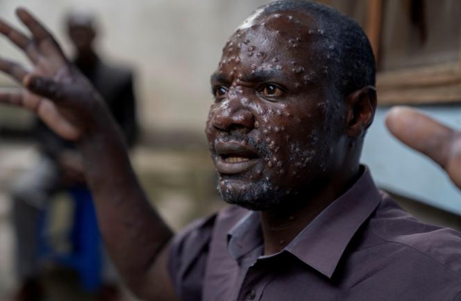 Jean Kakuru Biyambo, 48 ans, atteint du mpox,  à l’hôpital de Goma, en République démocratique du Congo, le 16 juillet 2024. 