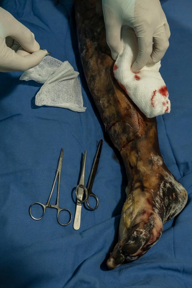The leg of a patient with 75% burns, at Geitaoui Hospital in Beirut, on October 4, 2024.