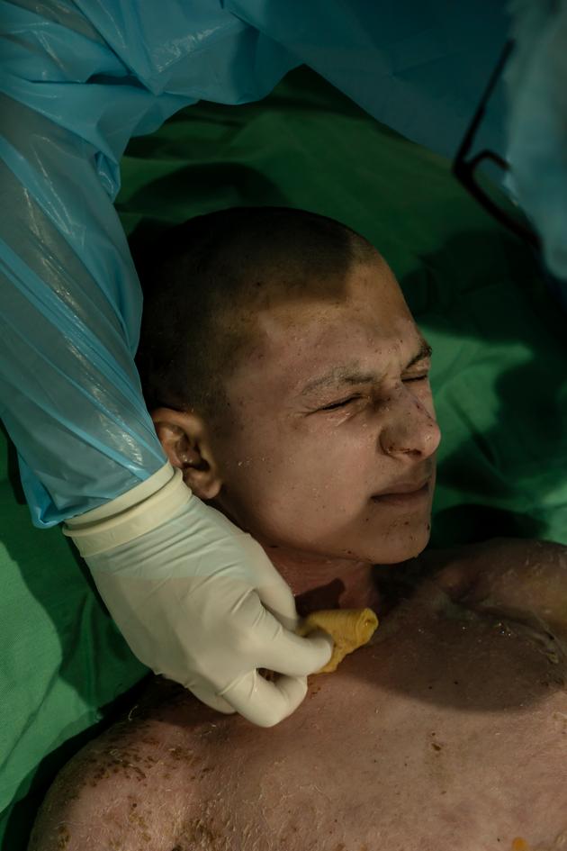Hussein, 15, 55% burned, here at Geitaoui Hospital, Lebanon's only burn treatment center, in Beirut, on October 4, 2024. 