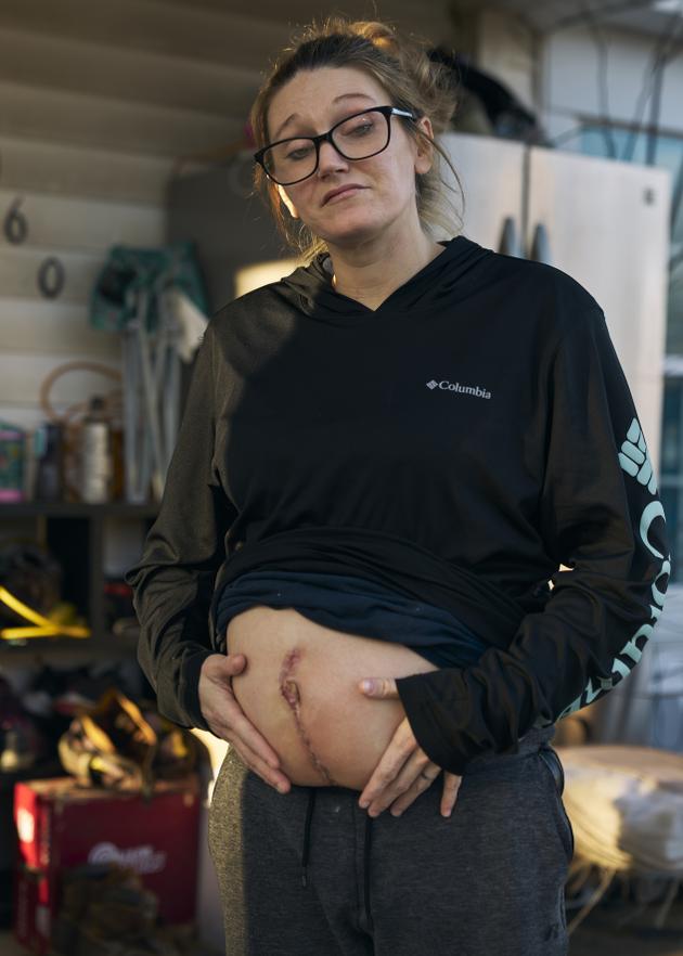 Mayron York-Hollis shows the scar from her C-section, at her home in Clarksville, Tennessee, December 17, 2022.