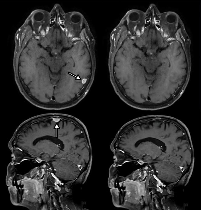 A gauche, deux IRM de patients présentant des tumeurs au cerveau (signalées par des flèches). A droite, les tumeurs ont été effacées par un outil de traitement d’images, à base d’intelligence artificielle générative, installé sur un téléphone Samsunsg S23.