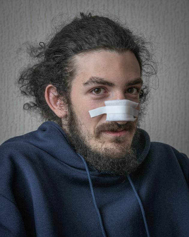 Zviad Maisachvili, 23, was beaten unconscious on the ground by a police officer. He has a broken nose, concussion and multiple wounds on his body. Tbilisi, December 8, 2024.