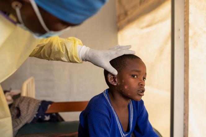 Vérification des lésions cutanées d’un enfant atteint de Mpox, au centre de traitement de Munigi, près de Goma (République démocratique du Congo), le 19 juillet 2024.