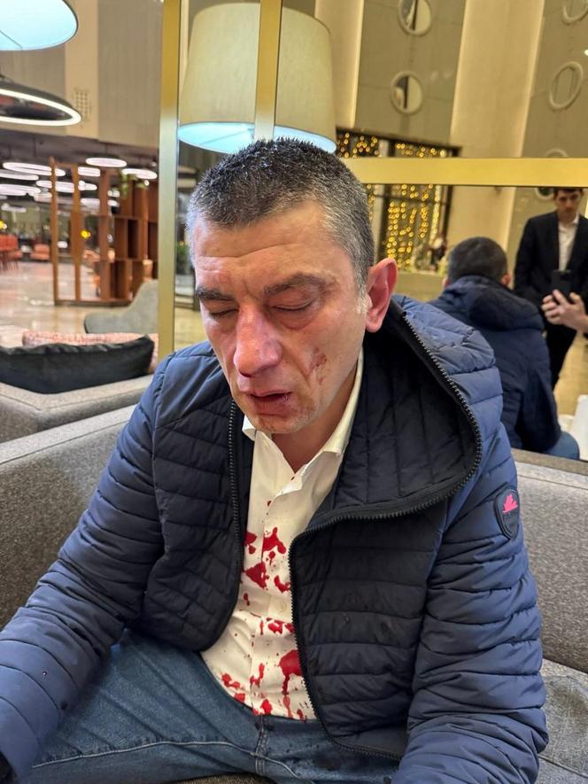 Ex-primeiro-ministro Guiorgui Gakharia, após seu ataque em 15 de janeiro de 2025, na Geórgia.