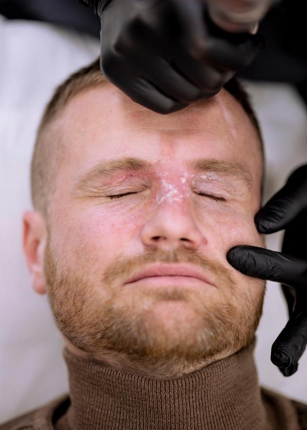 Ukrainian veteran Vitali Lykhobytsky undergoes facial reconstruction treatment, as part of the 'Unburned' program, at a clinic in Kyiv, on March 7, 2025.