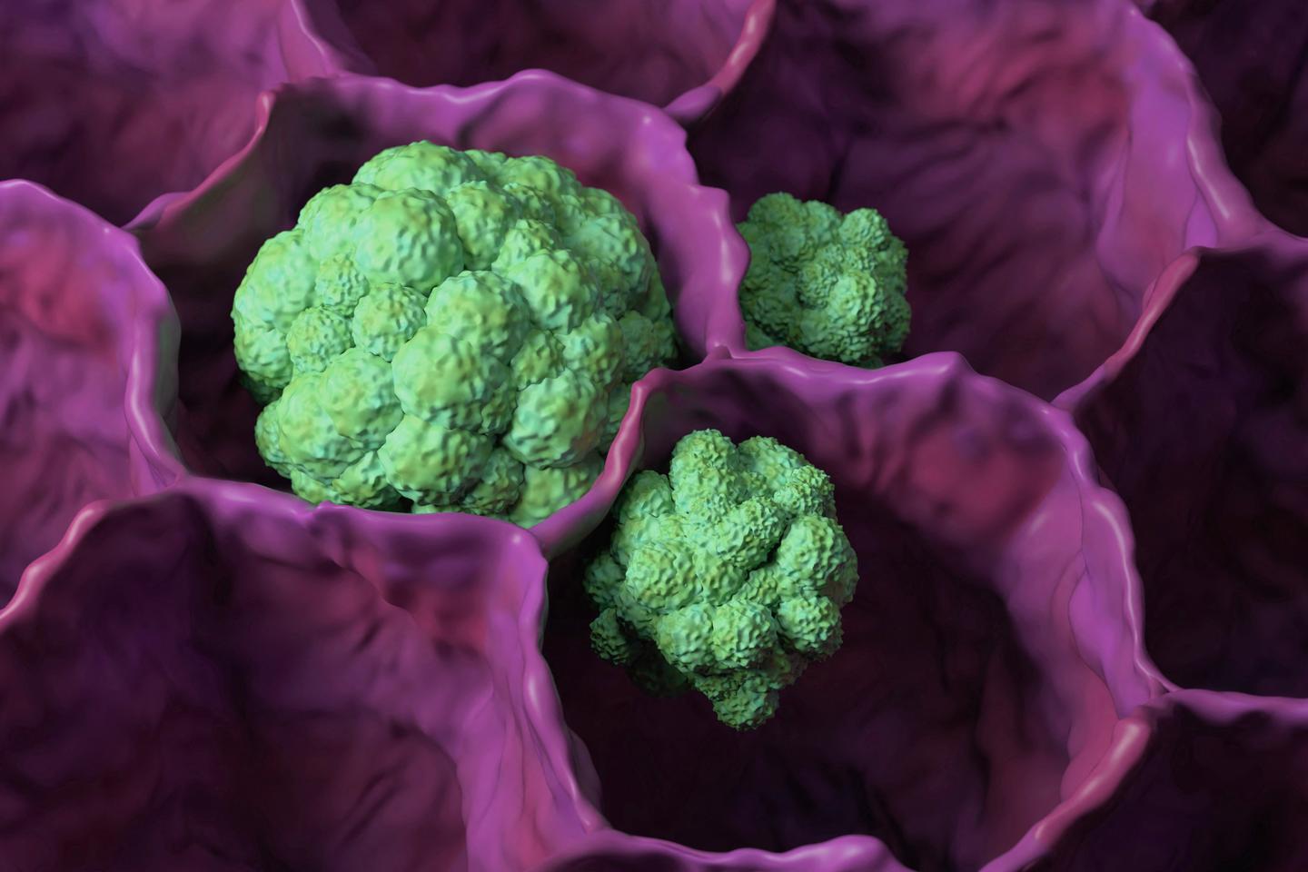 Inflammatory Cells & Prognosis - News Directory 3