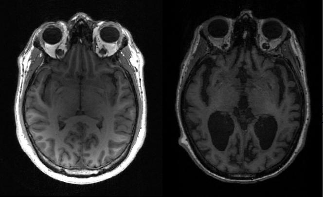 Image IRM d’un cerveau sain (à gauche) et d’un cerveau atteint de la maladie d’Alzheimer (à gauche) avec de larges espaces noirs où le cerveau a rétréci. Des amas de protéines toxiques, considérés comme responsables du déclin cognitif associé à la maladie d’Alzheimer, atteignent précocement différentes régions du cerveau et s’accumulent ensuite au cours des décennies.