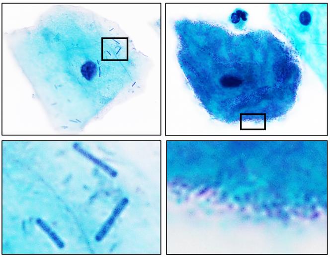 La flore vaginale « normale » (colonne de gauche) est principalement composée de lactobacilles en forme de bâtonnets, tandis que la vaginose bactérienne (colonne de droite) se caractérise par une prolifération de bactéries qui peuvent être de plusieurs espèces.
