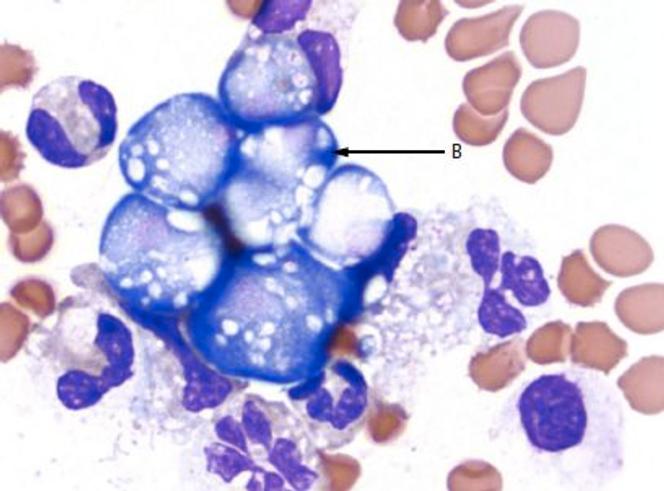 Liquide céphalorachidien après coloration au Wright-Giemsa (grossissement x 1 000). Enfant de 16 mois atteint d'une méningo-encéphalite amibienne primaire mortelle. La flèche B montre un amas d’amibes Naegleria fowleri.