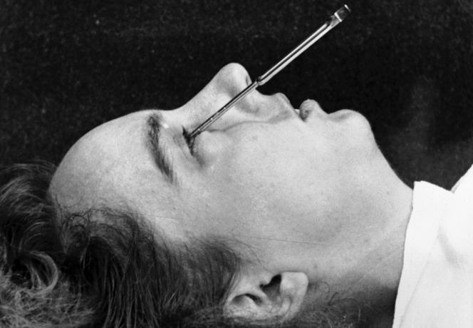 Une lobotomie transorbitale réalisée sur un patient par le médecin américain Walter Freeman, en 1949.