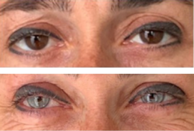 Kératopigmentation assistée par laser femtoseconde. À gauche : vue préopératoire de l’iris de couleur brune. À droite : vue postopératoire de la cornée de couleur verte. Ces documents ne correspondent pas au cas décrit dans ce post de blog.