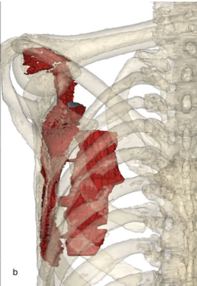 Visualisation 3D de l’hématome de l’épaule.