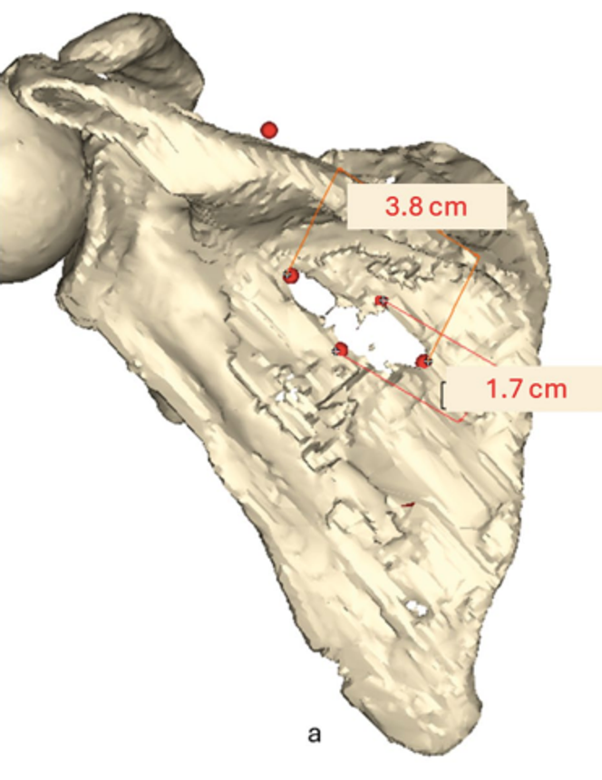 Visualisation 3D de l’omoplate gauche avec les dimensions du trou dans l’os.