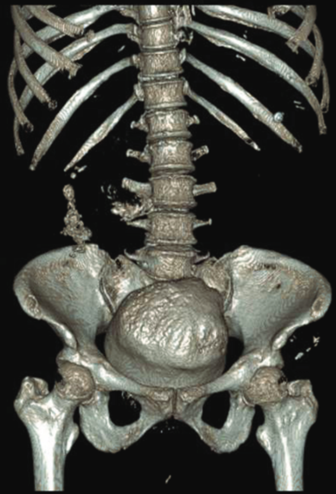 Femme de 56 ans. Reconstruction tridimensionnelle du calcul vésical.