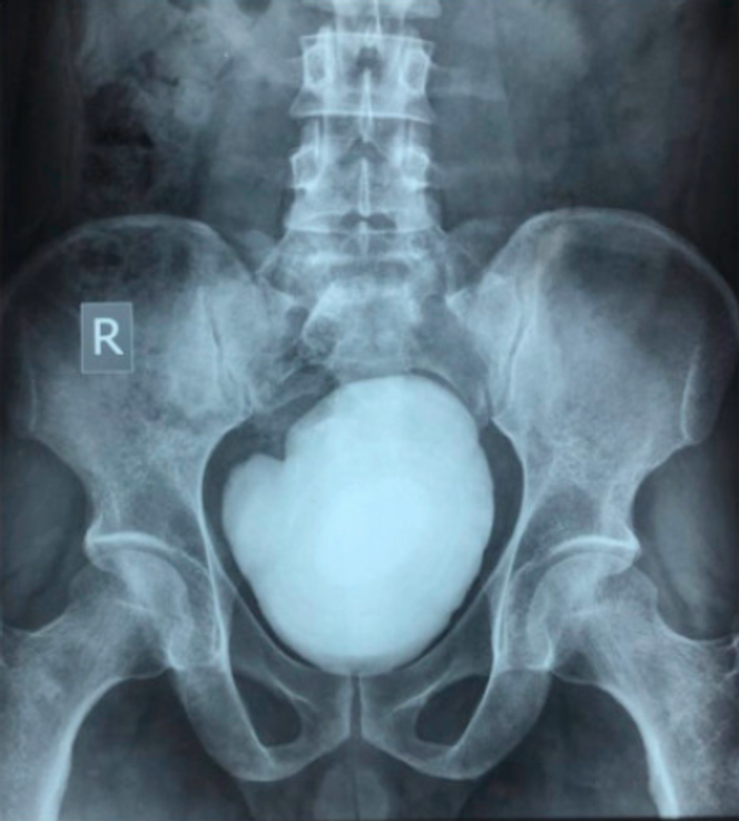 Radiographie préopératoire montrant un très gros calcul vésical occupant le bassin.