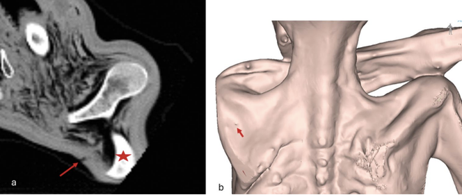 Visualisation de la plaie. (a) Image montrant la blessure au niveau de la peau, (flèche) ; l’étoile indique
l' ;omoplate gauche. (b) Visualisation 3D de la peau, montrant la blessure (flèche).