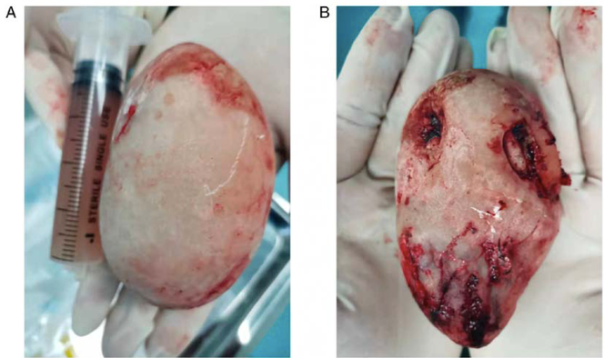 Calcul vésical géant après extraction de forme ovale (11 cm). (A) Vue supérieure. (B) Vue inférieure. La
seringue visible sur la photo est une seringue standard de 20 ml contenant le liquide drainé de la vessie
pendant l’opération, après lavage de la vessie avec du sérum physiologique.