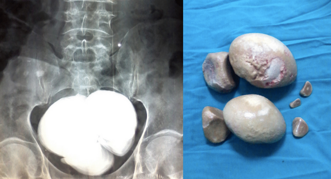Plusieurs gros calculs vésicaux chez un patient présentant des troubles neurogènes de la miction. A gauche : radiographie montrant des calculs vésicaux denses et superposés. A droite : aspect de ces calculs après leur extraction chirurgicale de la vessie (cystolithotomie).