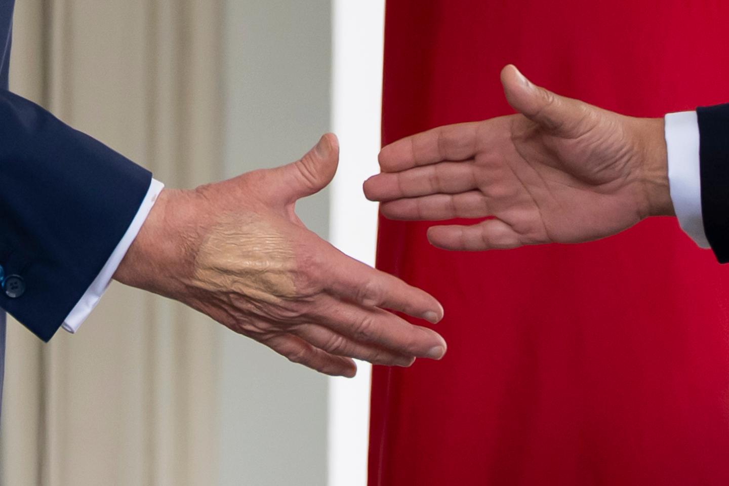 Trump diagnosed with vein condition after leg swelling, hand bruising