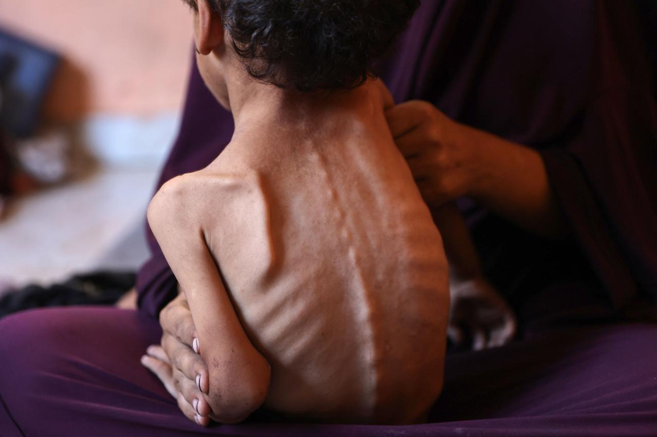 Cette photographie réalisée par Omar Al-Qattaa montre Yazan, un enfant de 2 ans souffrant de malnutrition, dans les bras de sa mère, Naeema, dans le camp de réfugiés d’Al-Chati (bande de Gaza), le 23 juillet 2025.