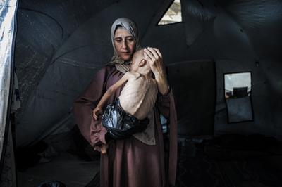 Muhammad Zakariya Ayyoub al-Matouq, un enfant d’un an et demi de la ville de Gaza, souffrant de malnutrition sévère, le 21 juillet 2025.