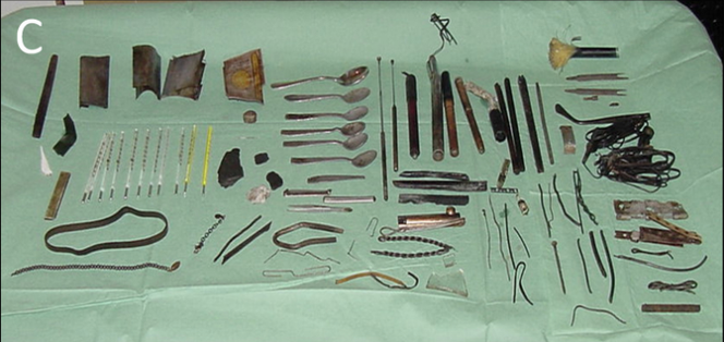 Photographie montrant les objets, nettoyés et triés, qui ont été retirés de l’estomac d’un patient de 38 ans souffrant de maladie mentale.