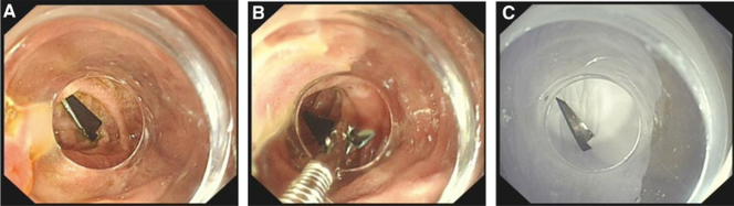 La fibroscopie gastrique a révélé que la lame de rasoir se trouvait dans le duodénum. Elle a été retirée à l’aide d’une pince.