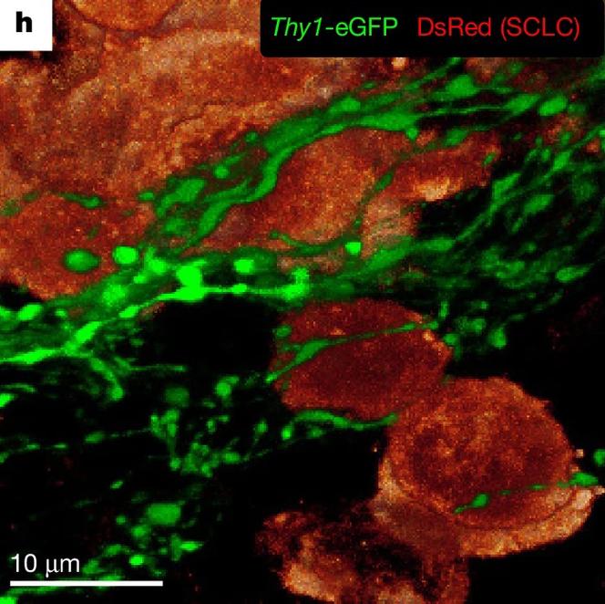 Reconstruction en 3D des cellules de cancer du poumon à petites cellules (en rouge), situées à la périphérie de la tumeur, et qui sont entourées d’axones (en vert). 