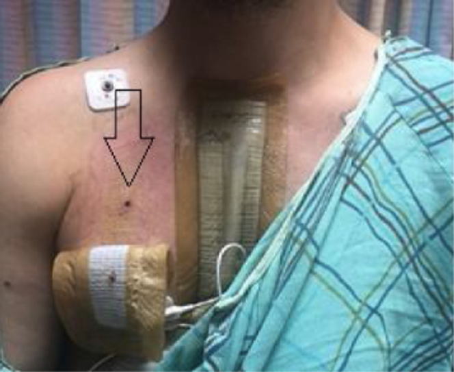 Orifice d’entrée d’une balle ayant migré dans le cœur. Cette photo concerne un cas différent de celui présenté au début de ce billet.  