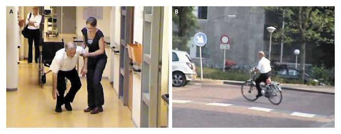 Ein 58-jähriger Mann mit Parkinson-Krankheit weist eine behindernde Gehblockade auf (Foto A). Die Fähigkeit des Patienten, Fahrrad zu fahren, ist erhalten (Foto B).