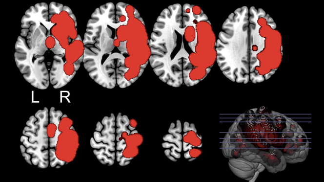 Angio-scanner : coupes étagées montrant (en rouge) les lésions de l’hémisphère cérébral droit. L : gauche.
R : droit. 