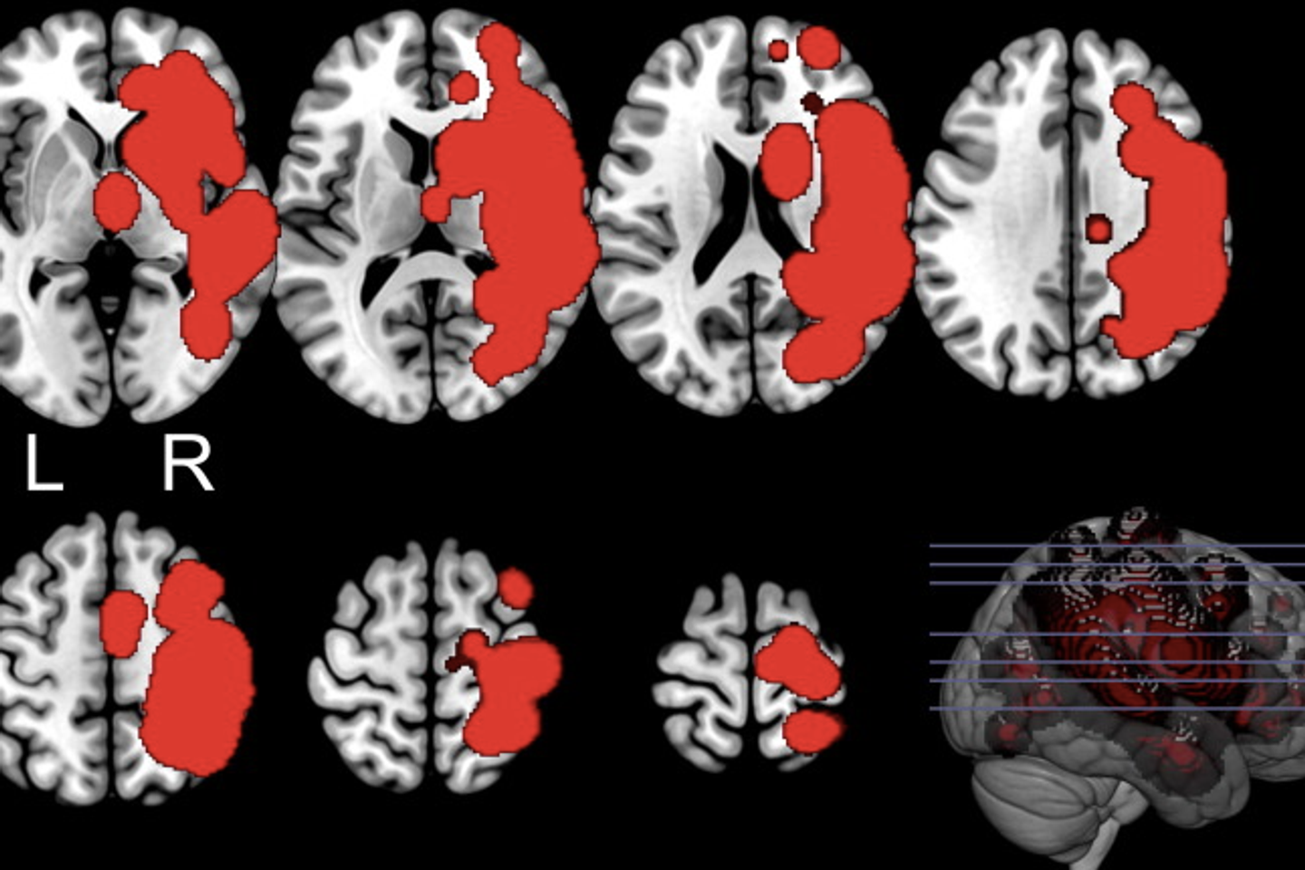 affirmer que sa main gauche paralysée n’est pas la sienne mais celle d’une autre personne